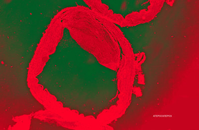 Атеросклеротическая бляшка на срезе кровеносного сосуда