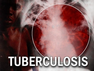 1297949443_tuberculosis