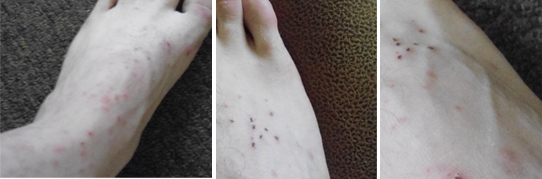 Искусанные блохами ноги одного их жильцов