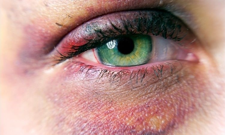 Оказания первой помощи при травмах глаз