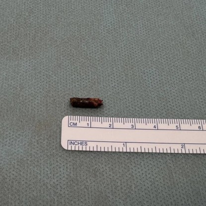 The fragment, which was a millimeter from his heart, photo: First Medical Association of Lviv