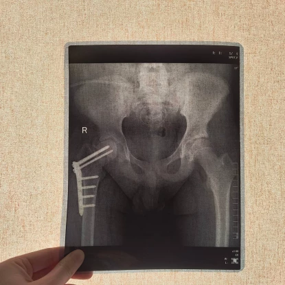 У Львові вперше в Україні підлітку зростили стегнову кістку стовбуровими клітинами. Фото: Дитяча лікарня Святого Миколая