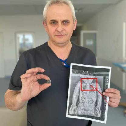 У Львові лікарі врятували дівчинку, яка кілька місяців жила з батарейкою у стравоході. Фото: Дитяча лікарня Святого Миколая