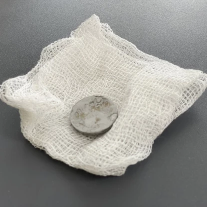 У Львові лікарі врятували дівчинку, яка кілька місяців жила з батарейкою у стравоході. Фото: Дитяча лікарня Святого Миколая